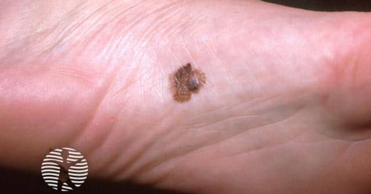 Clinical image of Acral lentiginous melanoma
