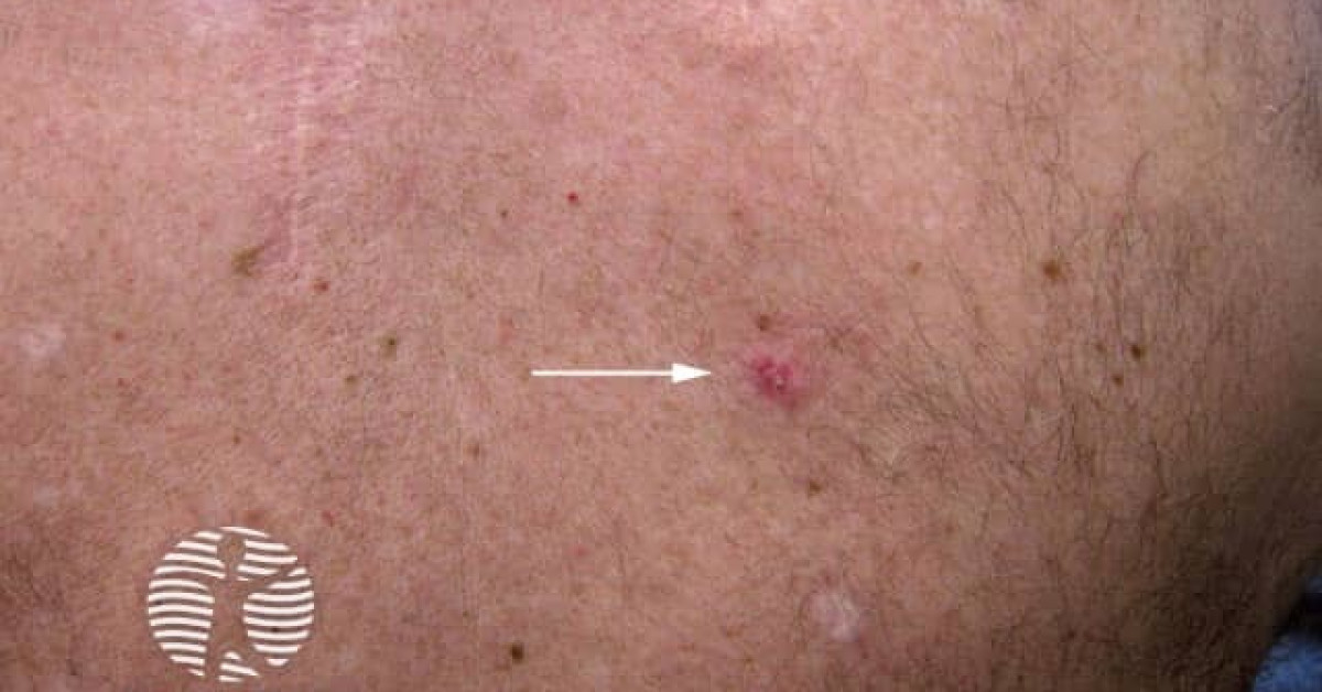 Clinical image of Adenoid cystic Ca of skin