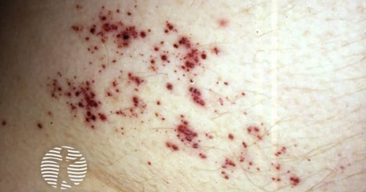 Clinical image of Angioma serpiginosum