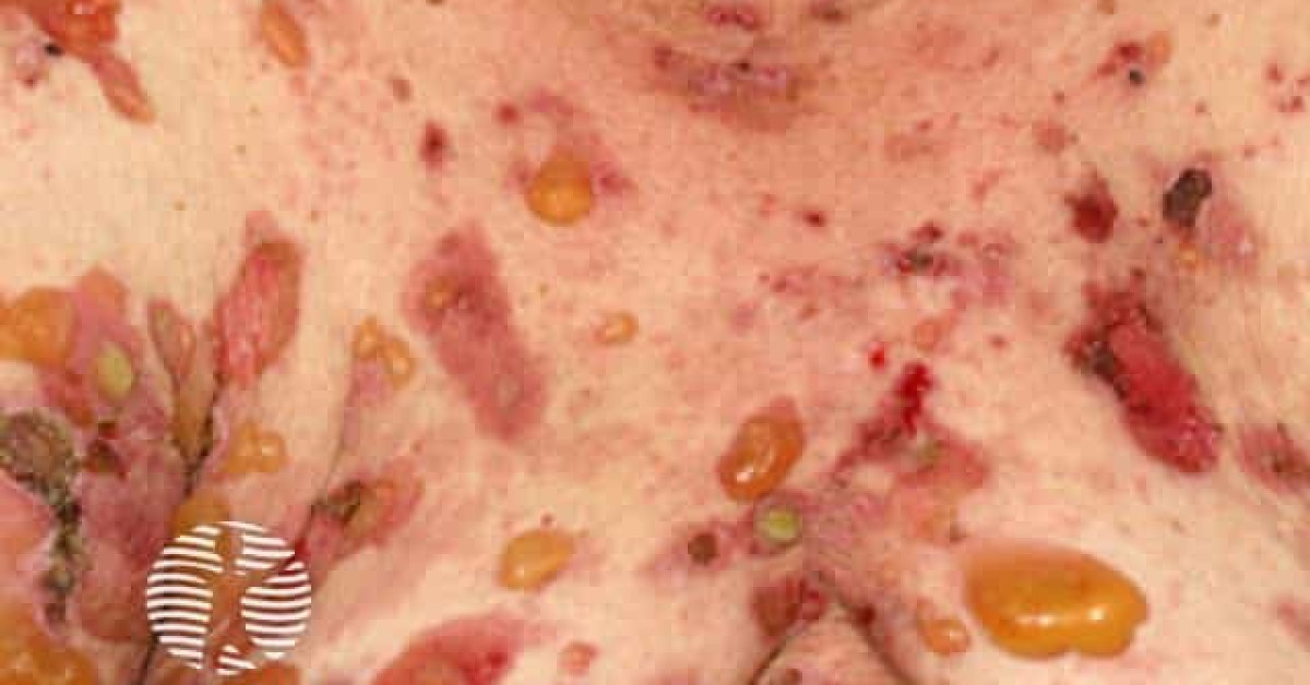 Clinical image of Bullous pemphigoid