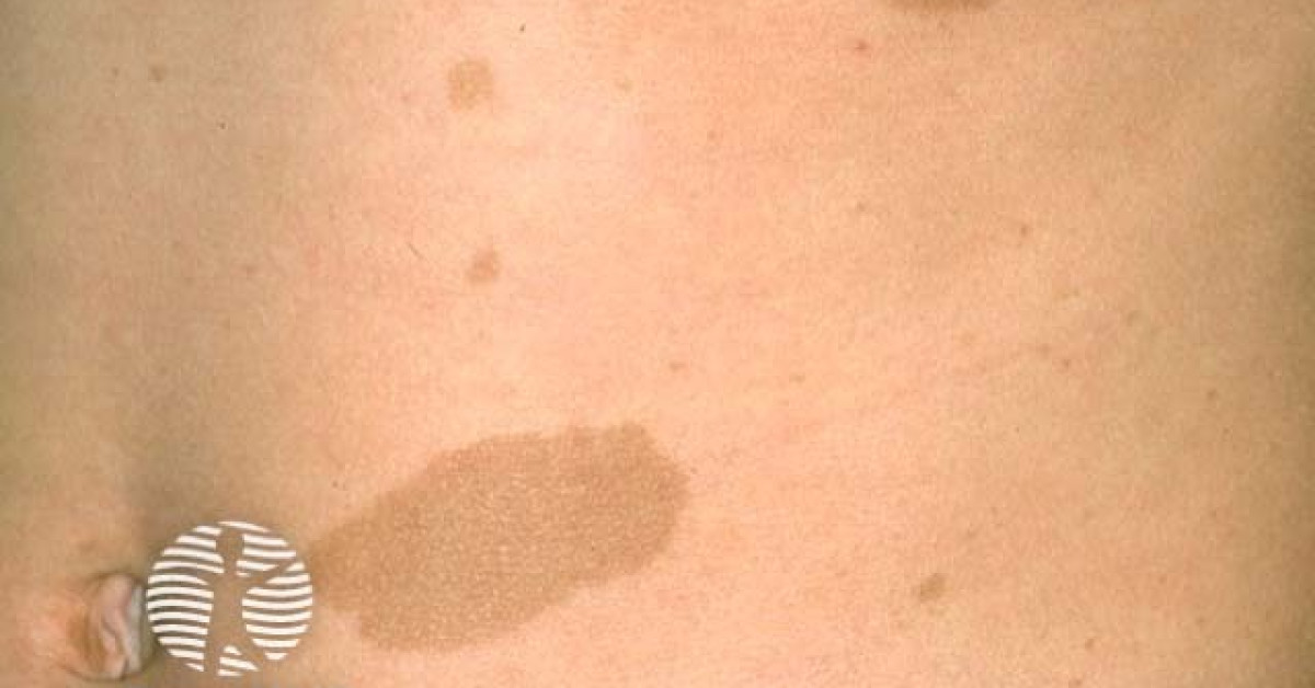 Clinical image of Café-au-lait macule