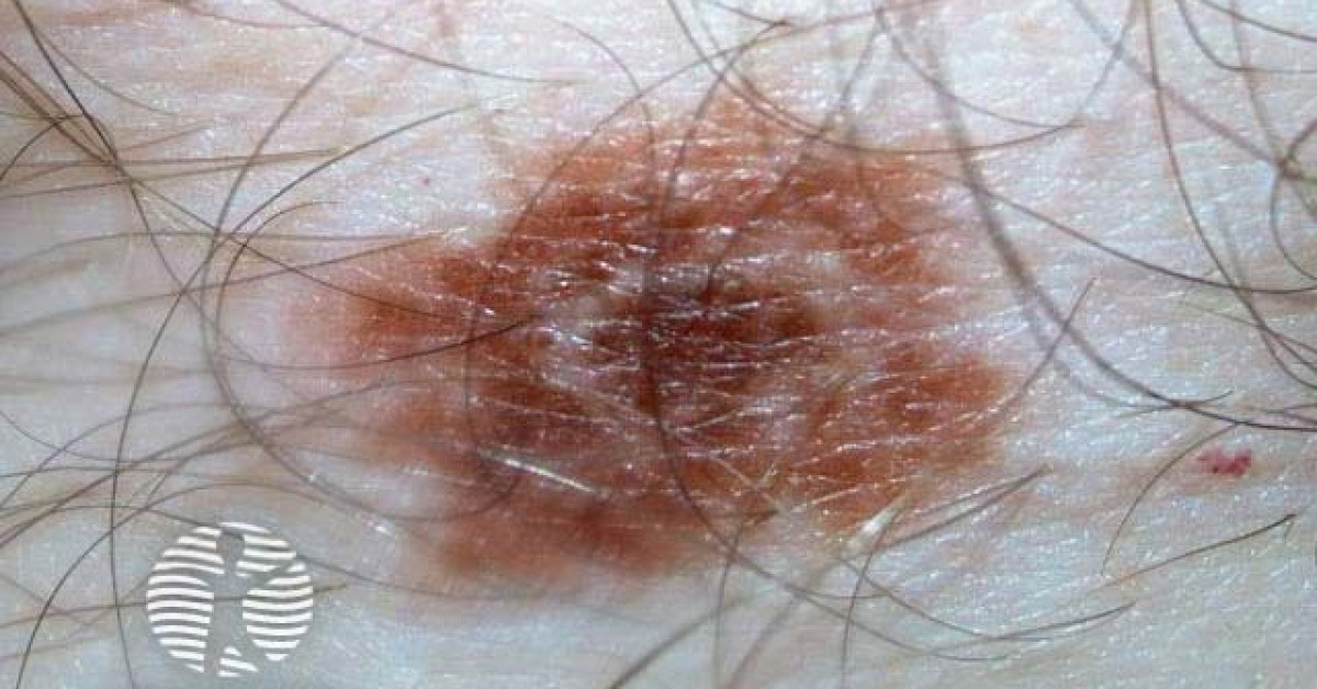 Clinical image of Cockade naevus