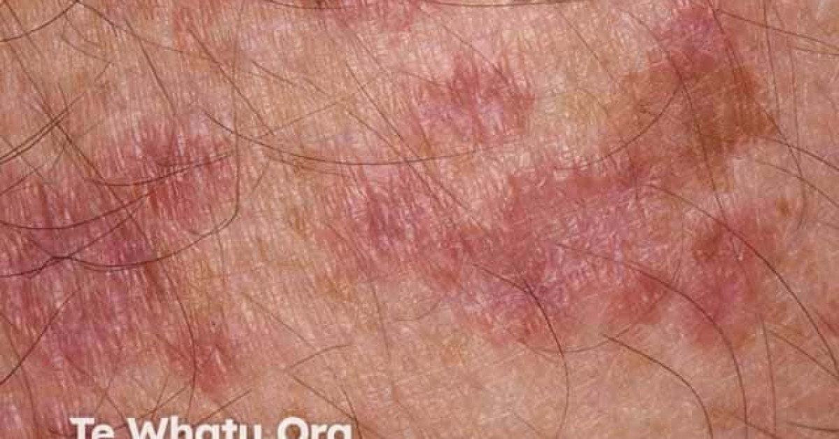 Clinical image of Cutaneous sarcoidosis