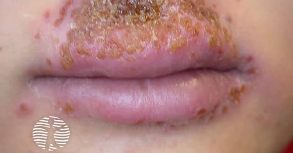 Clinical image of Eczema herpeticum & cutaneous HSV