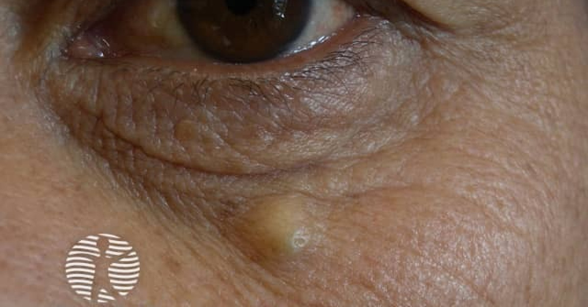 Clinical image of Epidermoid cyst