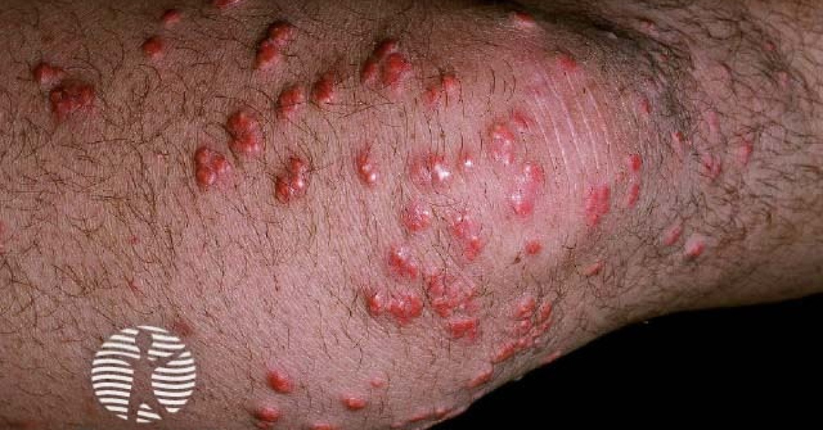 Clinical image of Eruptive xanthomas