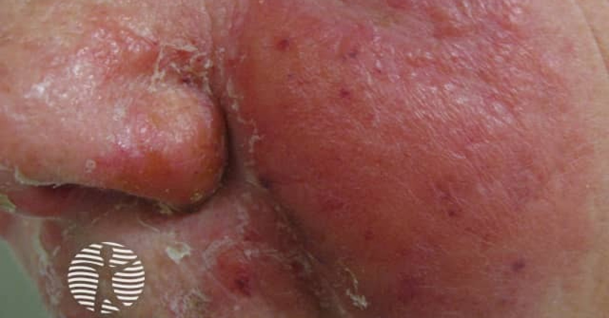 Clinical image of Erysipelas