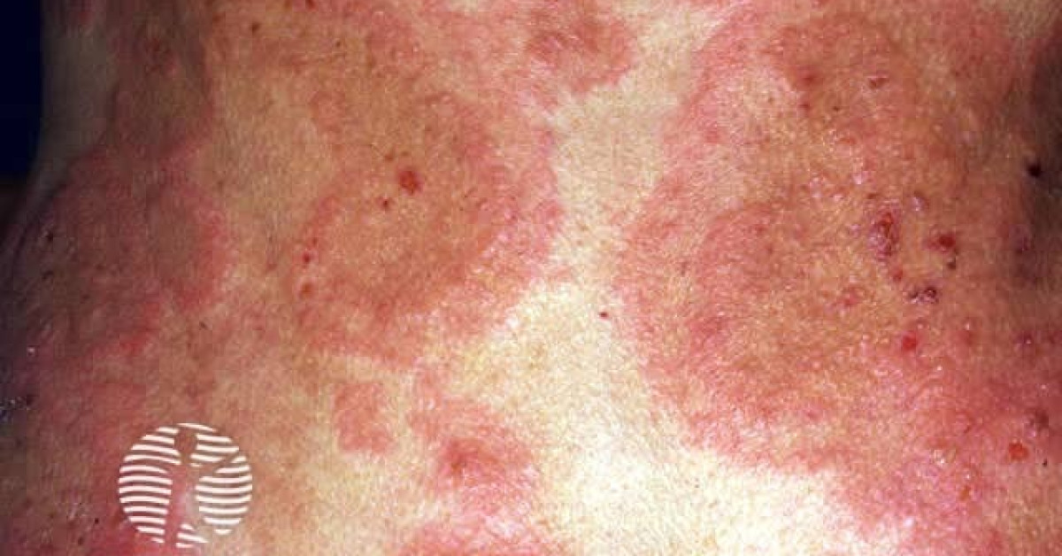 Clinical image of Erythema gyratum repens