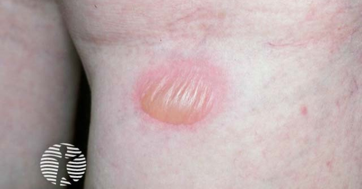 Clinical image of Fixed drug eruption
