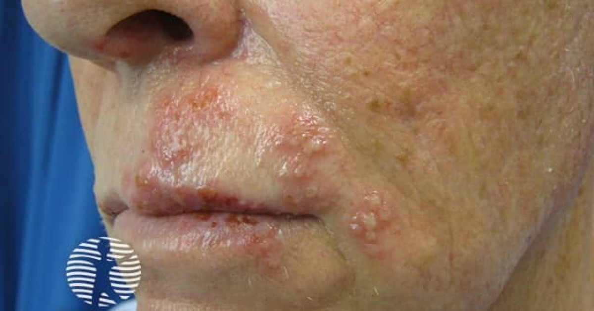 Clinical image of Herpes zoster (shingles)