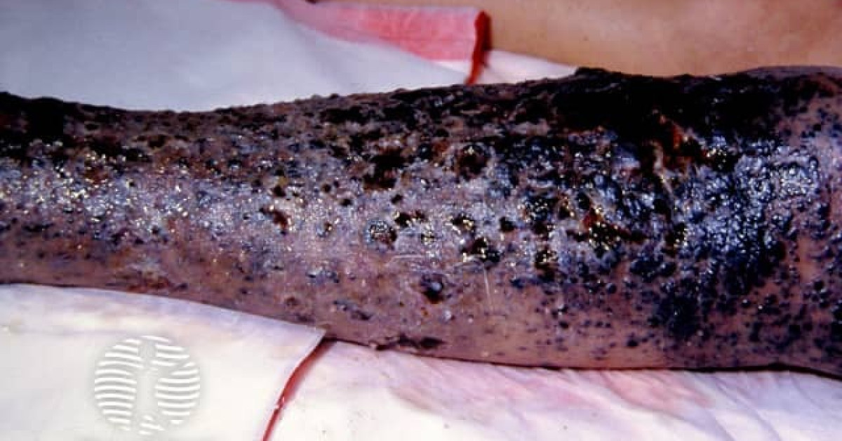 Clinical image of In-transit melanoma metastases
