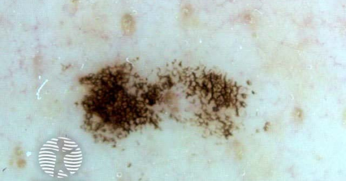 Clinical image of Lentigo simplex