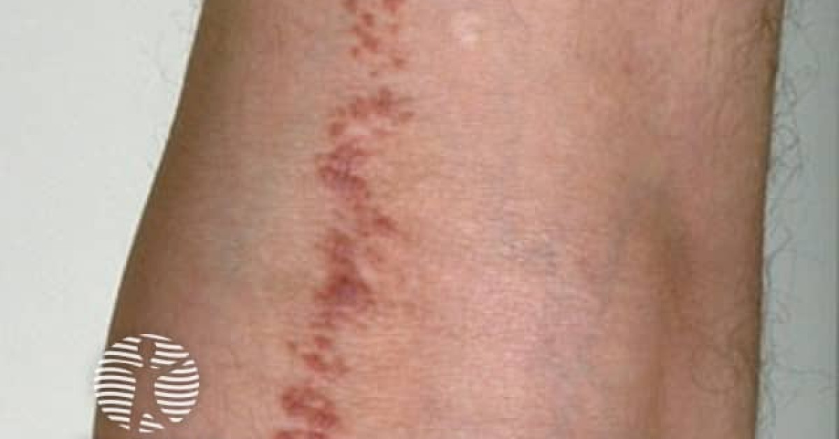 Clinical image of Lichen striatus