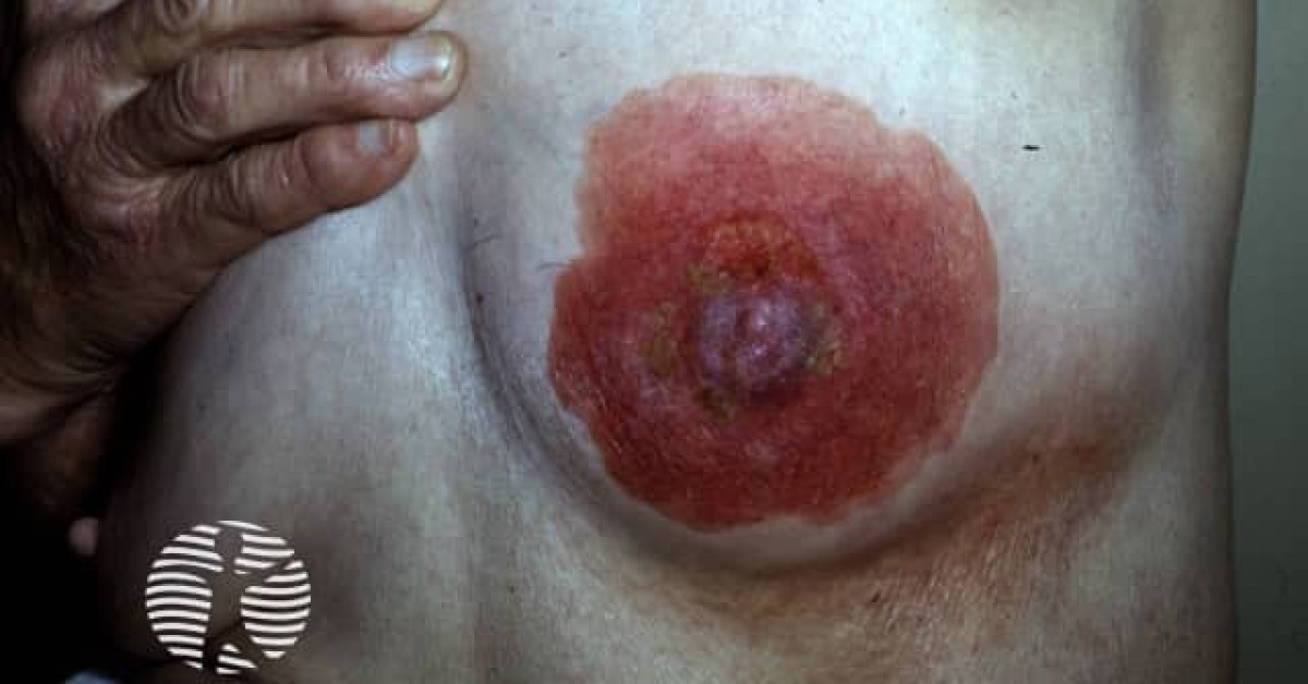 Clinical image of Mammary Paget's disease