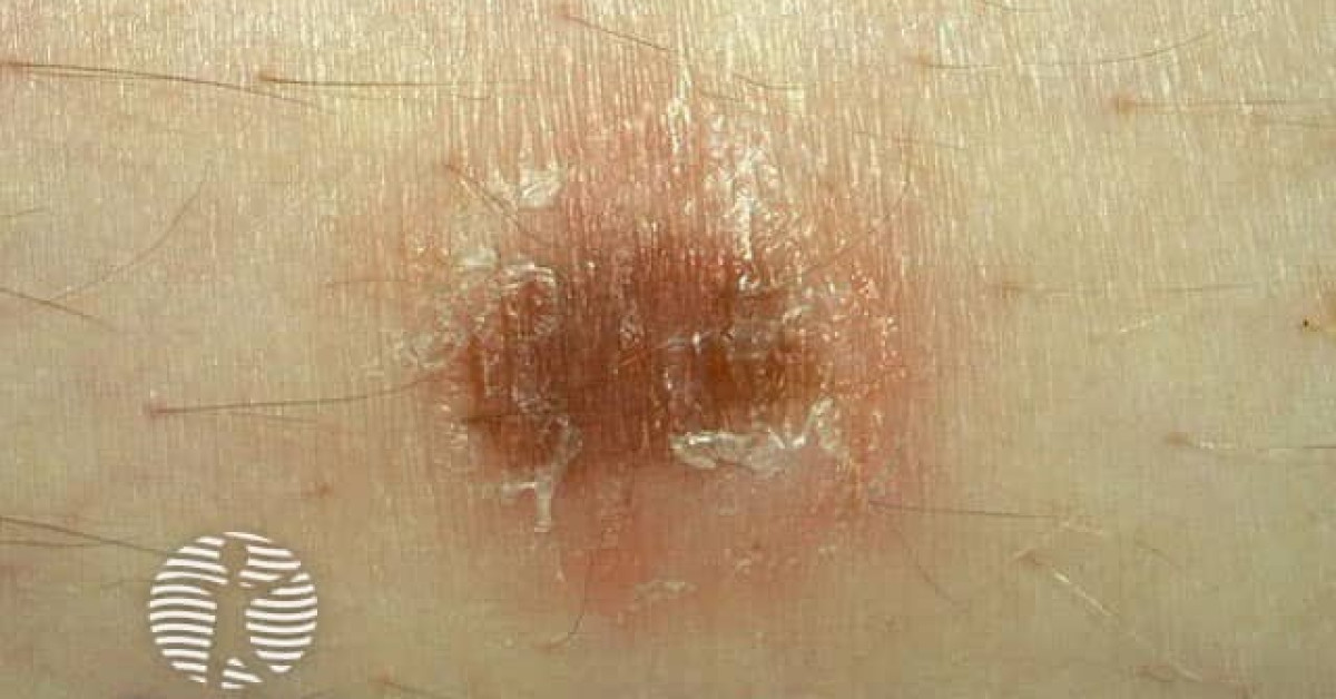 Clinical image of Meyerson naevus