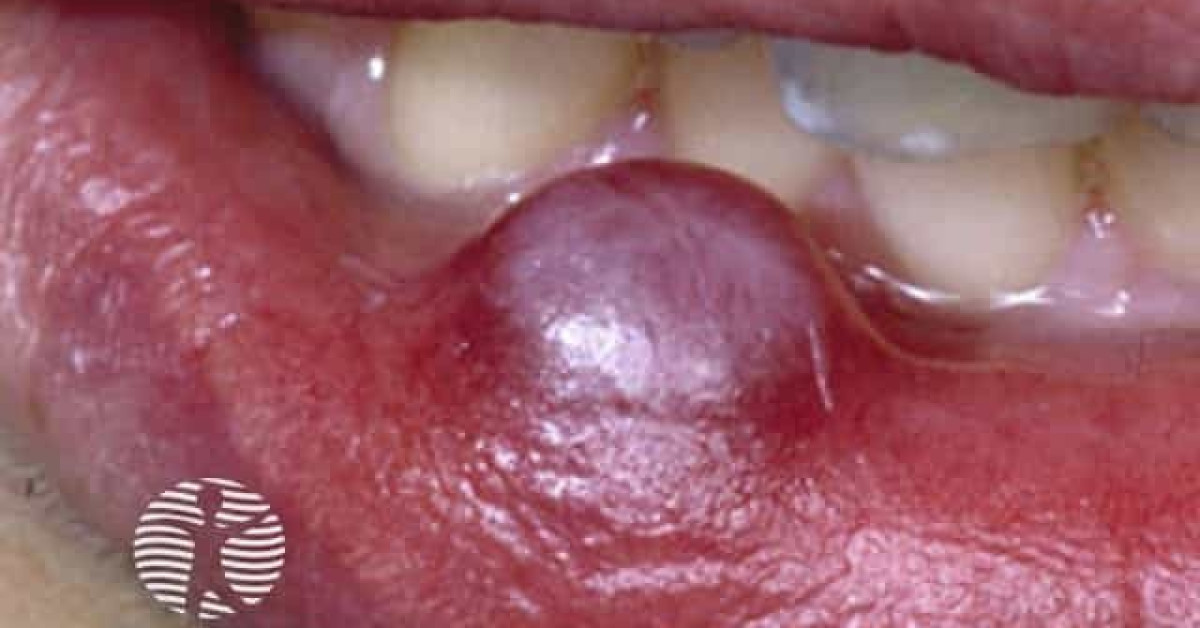 Clinical image of Mucocele