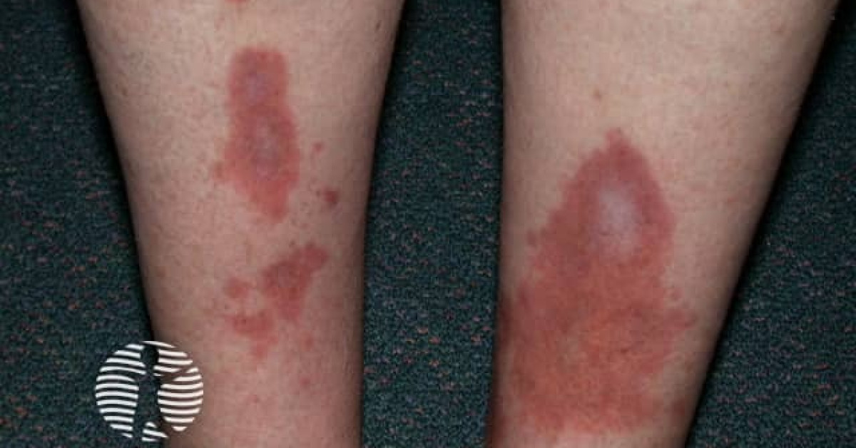 Clinical image of Necrobiosis lipoidica