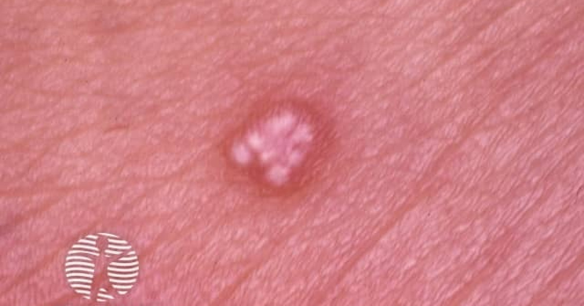 Clinical image of Pilomatrixoma