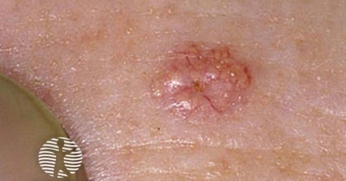 Clinical image of Sebaceous hyperplasia