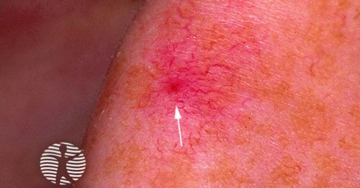 Clinical image of Spider naevus