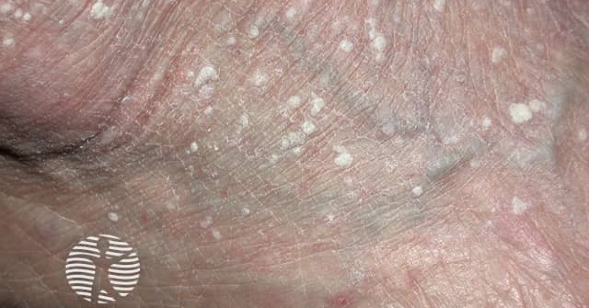 Clinical image of Stucco keratosis