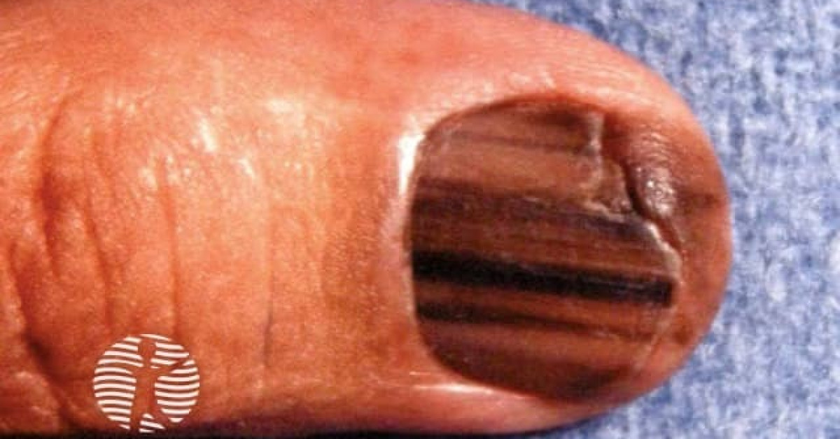 Clinical image of Subungual melanoma