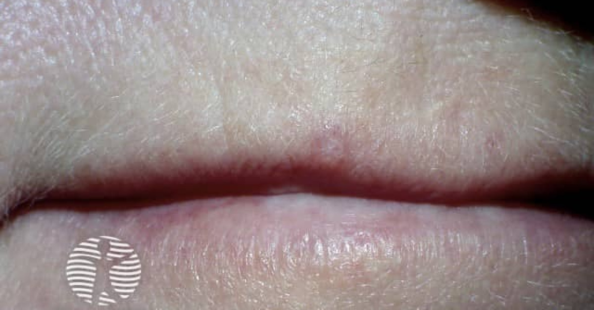 Clinical image of Trichilemmoma